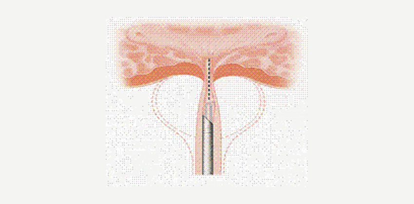 Διουρηθρική αυχενοτομή (bladder neck incision, BNI)