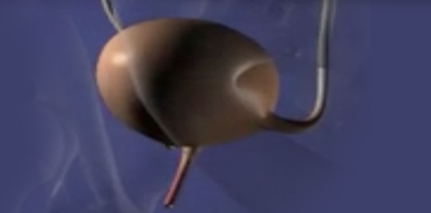 Ενδοκυστικές εγχυσεις Botox