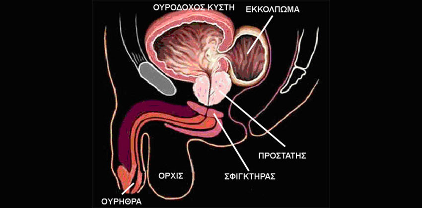 Εκκολπωματεκτομή