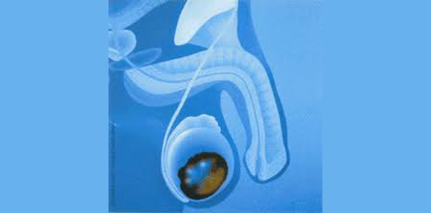 Καρκίνος Όρχεων