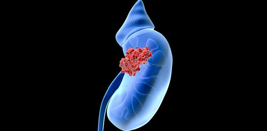 Καρκίνος Νεφρού