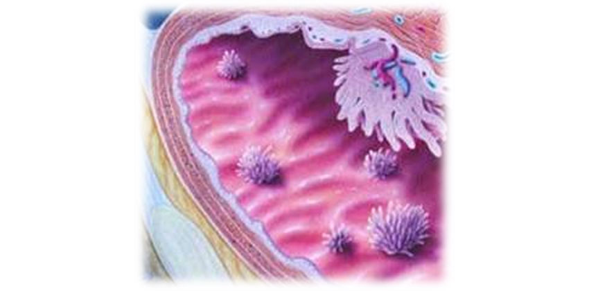 Καρκίνος Ουροδόχου Κύστης