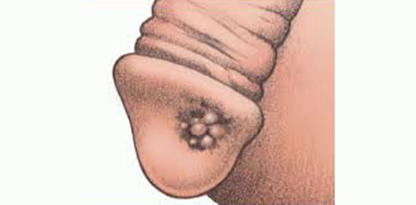 Καρκίνος Πέους