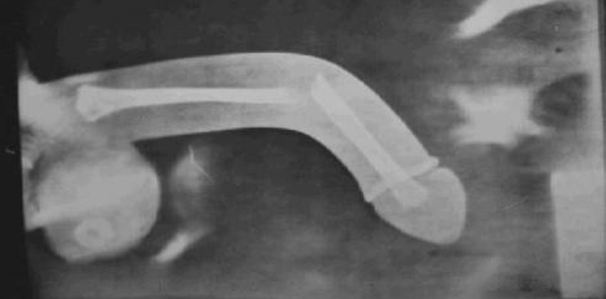 Κάταγμα Πέους