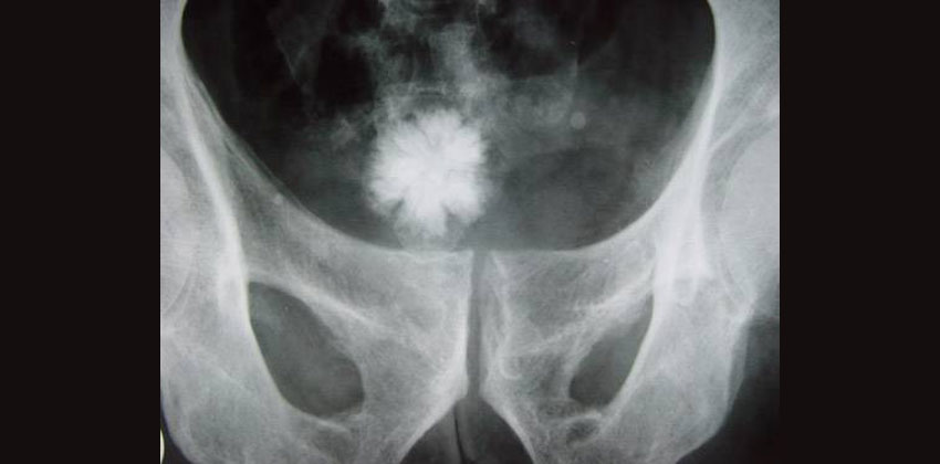 Λιθίαση Ουροδόχου Κύστεως