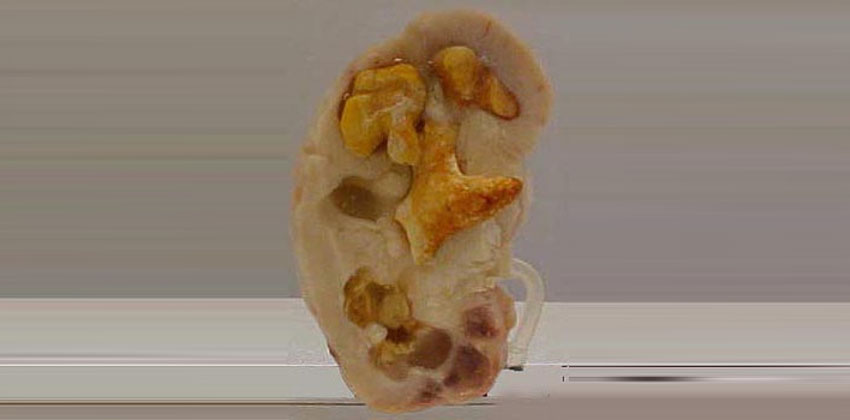 Λιθίαση Νεφρού