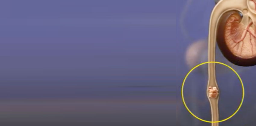 Λιθίαση Ουρητήρα