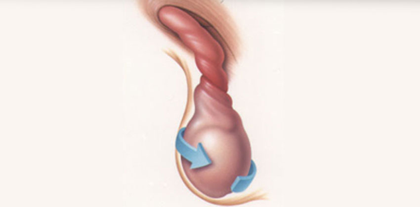 Συστροφή Όρχεως