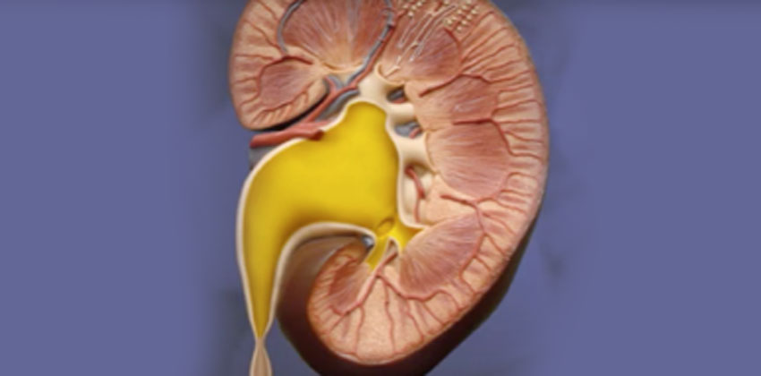 Στένωση Πυελοουρητηρικής Συμβολής 