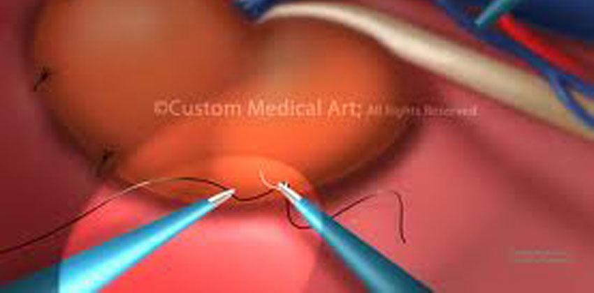 Νεφροπηξία