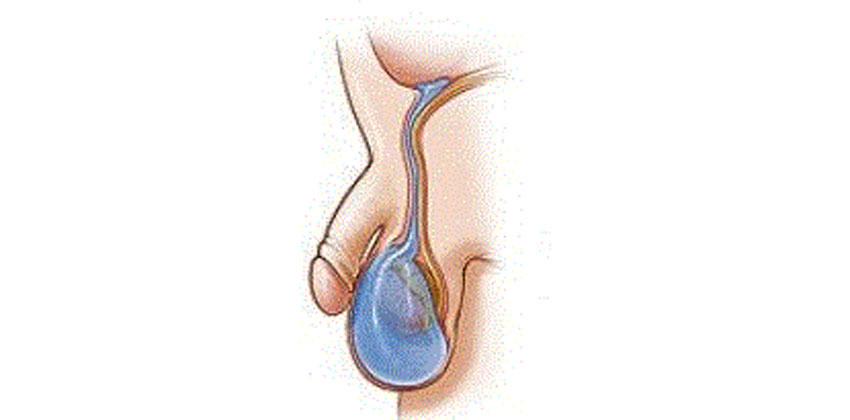 Πλαστική υδροκήλης