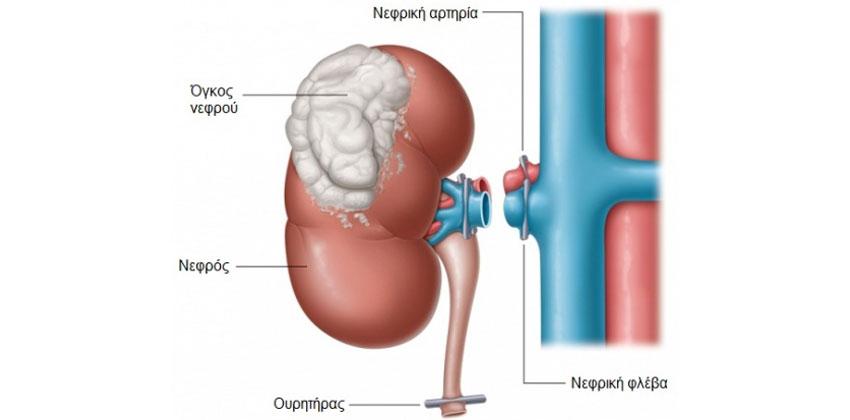 Ριζική νεφρεκτομή