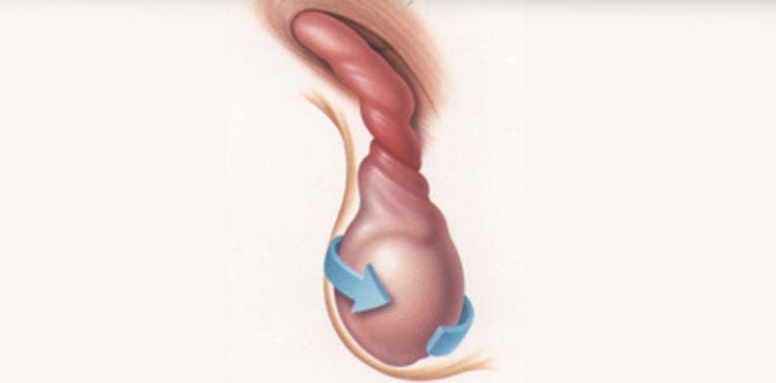 Συστροφή Όρχεως Συστροφή Όρχεως