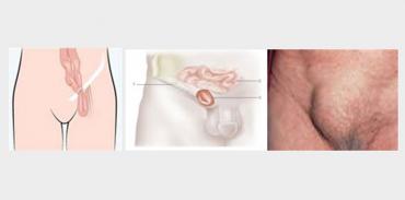 Διόρθωση Βουβωνοκήλης