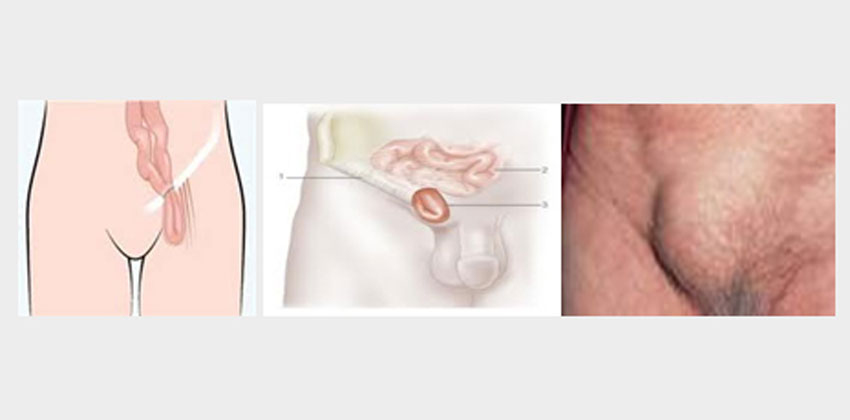 Βουβωνοκήλη